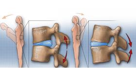 Nguyên nhân và cách chữa lồi đĩa đệm